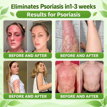 𝐏𝐔𝐑𝐄𝐋𝐎𝐑𝐀® 👩‍⚕️👩‍⚕️ 𝑰𝑳-23𝑹 𝑨𝒏𝒕𝒂𝒈𝒐𝒏𝒊𝒔𝒕 𝑷𝒆𝒑𝒕𝒊𝒅𝒆 + 𝑰𝒏𝒅𝒊𝒓𝒖𝒃𝒊𝒏 10-𝑰𝑵-1 𝑵𝒂𝒏𝒐 𝑴𝒊𝒄𝒓𝒐𝒏𝒆𝒆𝒅𝒍𝒆 𝑷𝒂𝒕𝒄𝒉 （𝑯𝒆𝒍𝒑𝒔 𝑹𝒆𝒅𝒖𝒄𝒆 𝑽𝒊𝒔𝒊𝒃𝒍𝒆 𝑹𝒆𝒅𝒏𝒆𝒔𝒔 & 𝑺𝒄𝒂𝒍𝒊𝒏𝒈, 𝑺𝒐𝒐𝒕𝒉𝒆 𝑫𝒓𝒚𝒏𝒆𝒔𝒔 & 𝑰𝒕𝒄𝒉𝒊𝒏𝒈, 𝑺𝒖𝒑𝒑𝒐𝒓𝒕 𝑯𝒆𝒂𝒍𝒕𝒉𝒊𝒆𝒓 𝑺𝒌𝒊𝒏 𝑪𝒆𝒍𝒍 𝑻𝒖𝒓𝒏𝒐𝒗𝒆𝒓 & 𝑺𝒌𝒊𝒏 𝑩𝒂𝒓𝒓𝒊𝒆𝒓 𝑹𝒆𝒑𝒂𝒊𝒓）