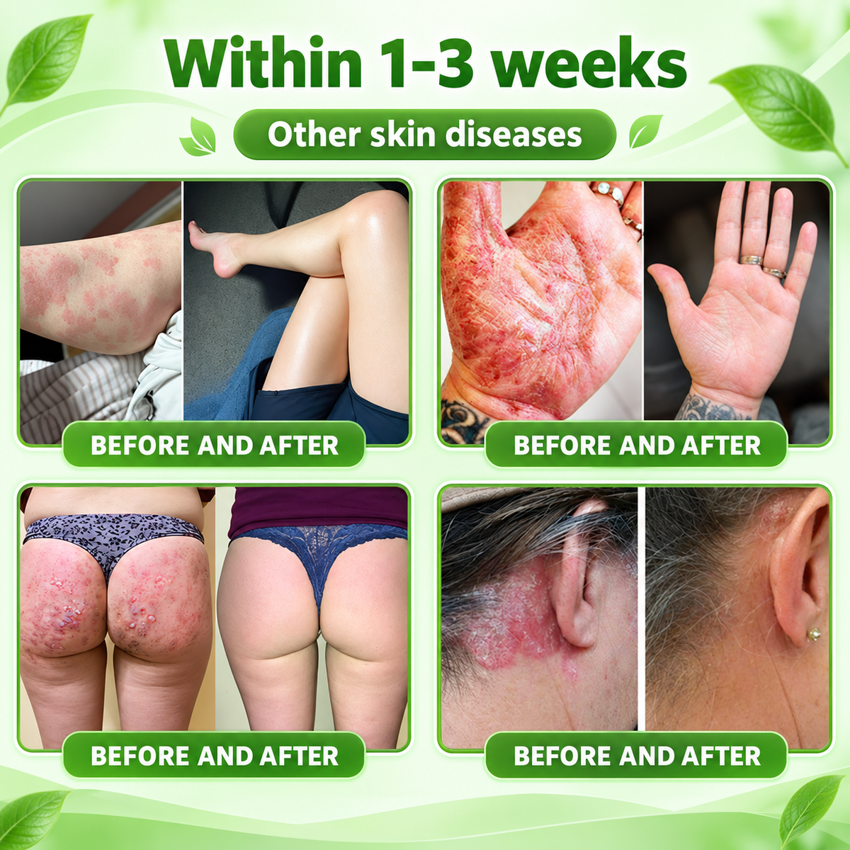 𝐏𝐔𝐑𝐄𝐋𝐎𝐑𝐀® 👩‍⚕️👩‍⚕️ 𝑰𝑳-23𝑹 𝑨𝒏𝒕𝒂𝒈𝒐𝒏𝒊𝒔𝒕 𝑷𝒆𝒑𝒕𝒊𝒅𝒆 + 𝑰𝒏𝒅𝒊𝒓𝒖𝒃𝒊𝒏 10-𝑰𝑵-1 𝑵𝒂𝒏𝒐 𝑴𝒊𝒄𝒓𝒐𝒏𝒆𝒆𝒅𝒍𝒆 𝑷𝒂𝒕𝒄𝒉 （𝑯𝒆𝒍𝒑𝒔 𝑹𝒆𝒅𝒖𝒄𝒆 𝑽𝒊𝒔𝒊𝒃𝒍𝒆 𝑹𝒆𝒅𝒏𝒆𝒔𝒔 & 𝑺𝒄𝒂𝒍𝒊𝒏𝒈, 𝑺𝒐𝒐𝒕𝒉𝒆 𝑫𝒓𝒚𝒏𝒆𝒔𝒔 & 𝑰𝒕𝒄𝒉𝒊𝒏𝒈, 𝑺𝒖𝒑𝒑𝒐𝒓𝒕 𝑯𝒆𝒂𝒍𝒕𝒉𝒊𝒆𝒓 𝑺𝒌𝒊𝒏 𝑪𝒆𝒍𝒍 𝑻𝒖𝒓𝒏𝒐𝒗𝒆𝒓 & 𝑺𝒌𝒊𝒏 𝑩𝒂𝒓𝒓𝒊𝒆𝒓 𝑹𝒆𝒑𝒂𝒊𝒓）