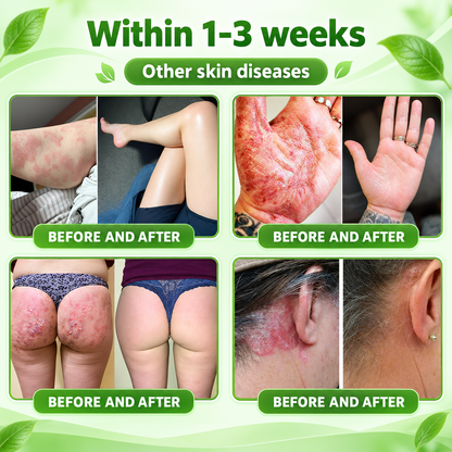 𝐏𝐔𝐑𝐄𝐋𝐎𝐑𝐀® 👩‍⚕️👩‍⚕️ 𝑰𝑳-23𝑹 𝑨𝒏𝒕𝒂𝒈𝒐𝒏𝒊𝒔𝒕 𝑷𝒆𝒑𝒕𝒊𝒅𝒆 + 𝑰𝒏𝒅𝒊𝒓𝒖𝒃𝒊𝒏 10-𝑰𝑵-1 𝑵𝒂𝒏𝒐 𝑴𝒊𝒄𝒓𝒐𝒏𝒆𝒆𝒅𝒍𝒆 𝑷𝒂𝒕𝒄𝒉 （𝑯𝒆𝒍𝒑𝒔 𝑹𝒆𝒅𝒖𝒄𝒆 𝑽𝒊𝒔𝒊𝒃𝒍𝒆 𝑹𝒆𝒅𝒏𝒆𝒔𝒔 & 𝑺𝒄𝒂𝒍𝒊𝒏𝒈, 𝑺𝒐𝒐𝒕𝒉𝒆 𝑫𝒓𝒚𝒏𝒆𝒔𝒔 & 𝑰𝒕𝒄𝒉𝒊𝒏𝒈, 𝑺𝒖𝒑𝒑𝒐𝒓𝒕 𝑯𝒆𝒂𝒍𝒕𝒉𝒊𝒆𝒓 𝑺𝒌𝒊𝒏 𝑪𝒆𝒍𝒍 𝑻𝒖𝒓𝒏𝒐𝒗𝒆𝒓 & 𝑺𝒌𝒊𝒏 𝑩𝒂𝒓𝒓𝒊𝒆𝒓 𝑹𝒆𝒑𝒂𝒊𝒓）