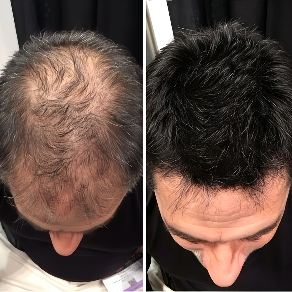 🌿👨‍⚕️ Official Canadian Flagship Store 🇨🇦 | 🔥PURELORA® Onion & Rosemary 2-in-1 Anti-Hair Loss & Growth Shampoo & Conditioner Set — Infused with a 15x hair-growth active complex to help you achieve thicker, fuller, and stronger hair.