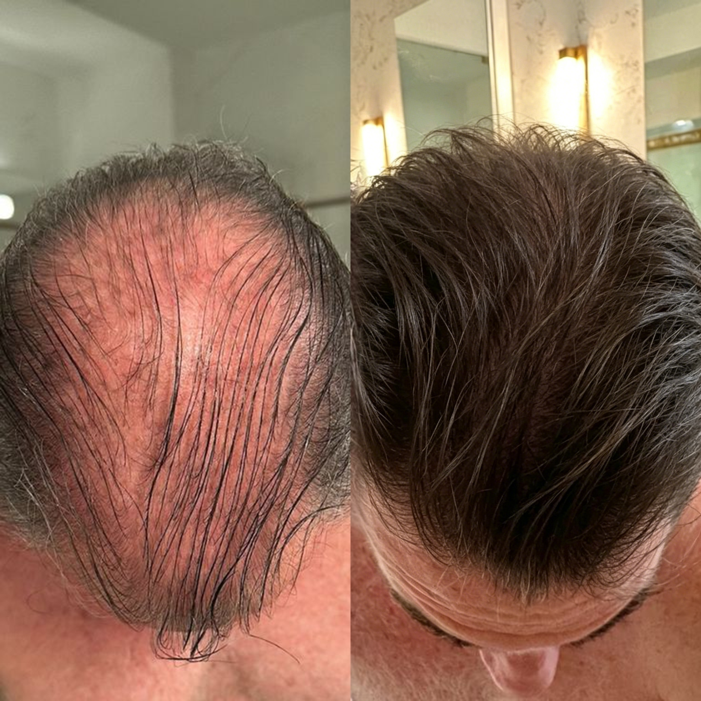 🌿👨‍⚕️ Official Canadian Flagship Store 🇨🇦 | 🔥PURELORA® Onion & Rosemary 2-in-1 Anti-Hair Loss & Growth Shampoo & Conditioner Set — Infused with a 15x hair-growth active complex to help you achieve thicker, fuller, and stronger hair.