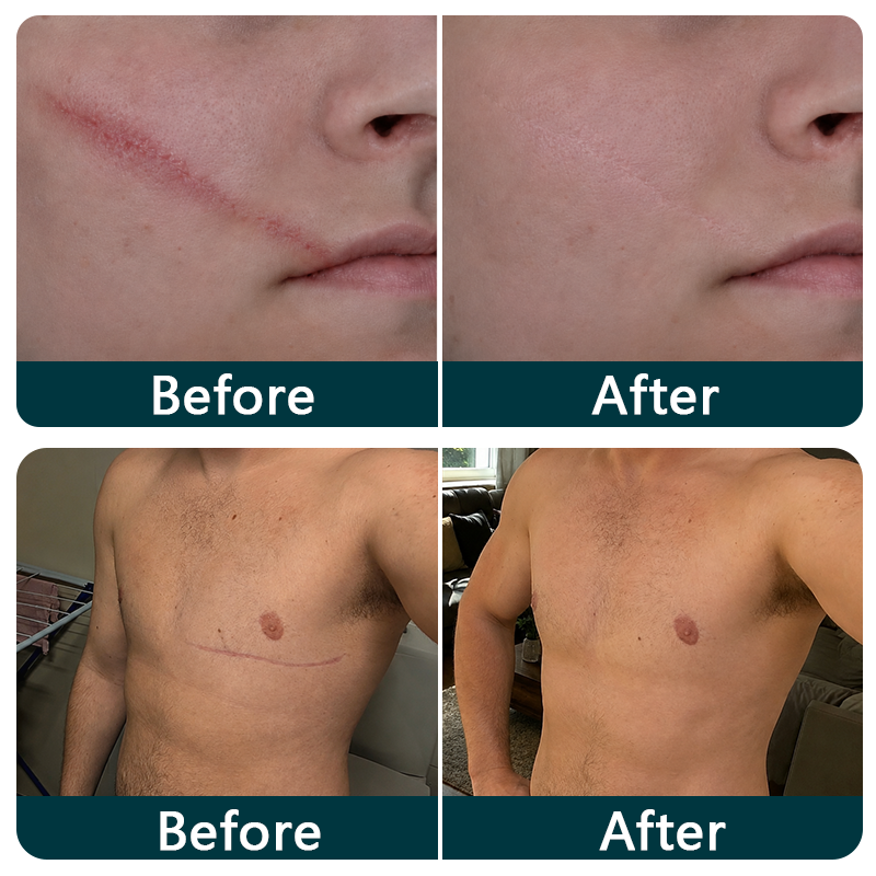 ✨💯Purelora® SILICONE SCAR THERAPY ROLL Help Soften, Flatten & Improve the Appearance of Raised Scars