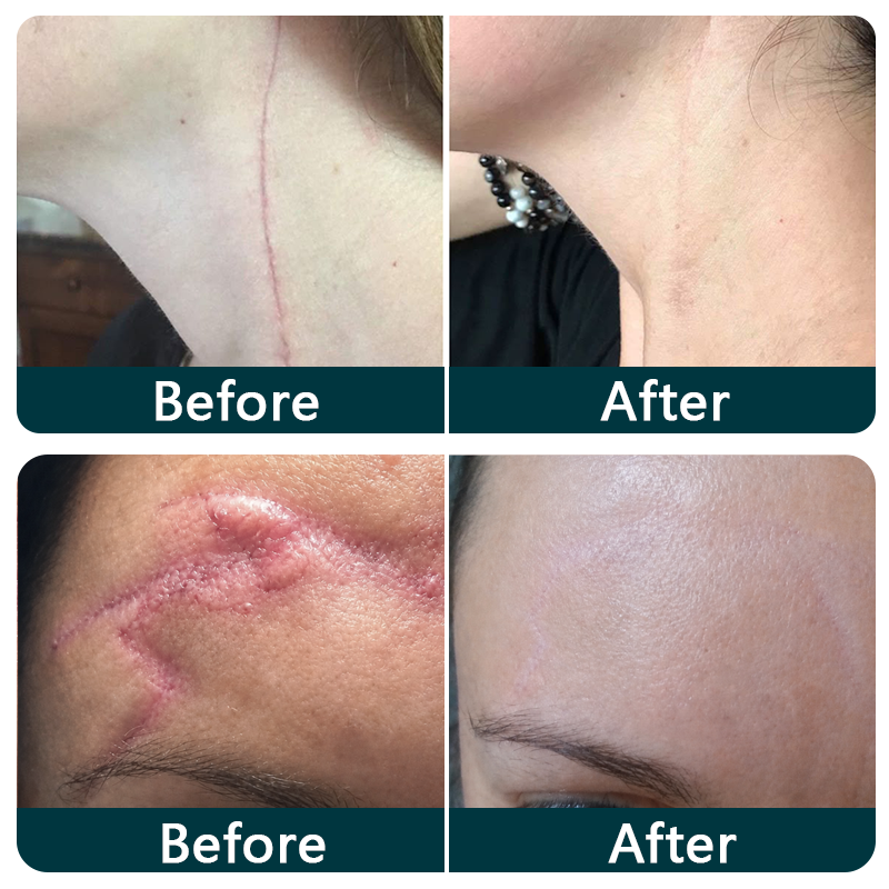 ✨💯Purelora® SILICONE SCAR THERAPY ROLL Help Soften, Flatten & Improve the Appearance of Raised Scars
