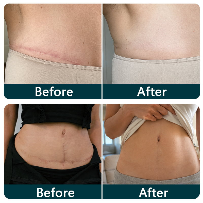 ✨💯Purelora® SILICONE SCAR THERAPY ROLL Help Soften, Flatten & Improve the Appearance of Raised Scars
