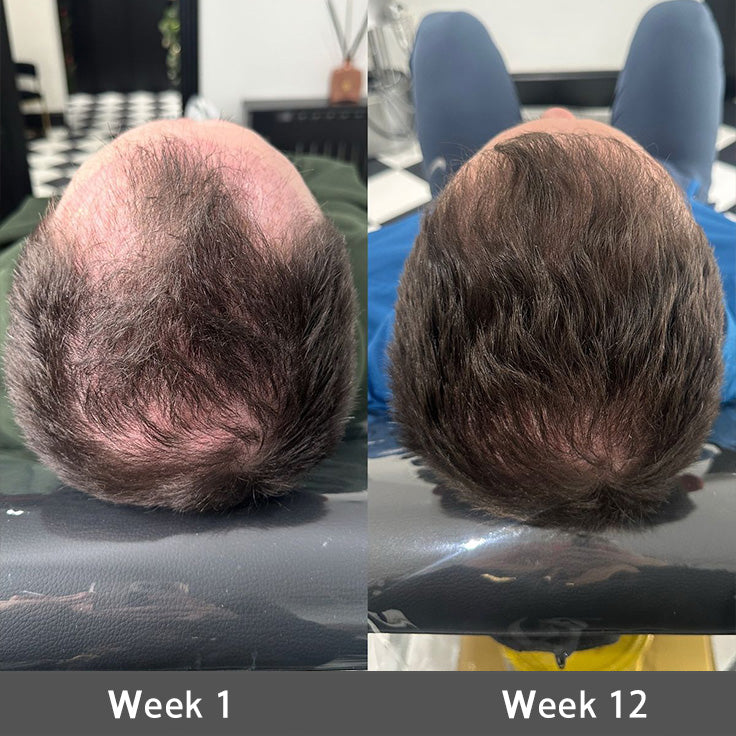 🌿👨‍⚕️ Official Canadian Flagship Store 🇨🇦 | 🔥PURELORA® Onion & Rosemary 2-in-1 Anti-Hair Loss & Growth Shampoo & Conditioner Set — Infused with a 15x hair-growth active complex to help you achieve thicker, fuller, and stronger hair.