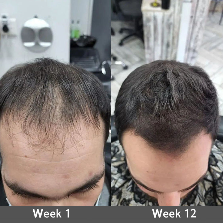 🌿👨‍⚕️ Official Canadian Flagship Store 🇨🇦 | 🔥PURELORA® Onion & Rosemary 2-in-1 Anti-Hair Loss & Growth Shampoo & Conditioner Set — Infused with a 15x hair-growth active complex to help you achieve thicker, fuller, and stronger hair.
