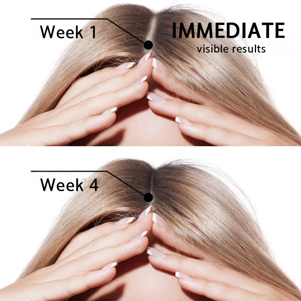 🌿👨‍⚕️ Official Canadian Flagship Store 🇨🇦 | 🔥PURELORA® Onion & Rosemary 2-in-1 Anti-Hair Loss & Growth Shampoo & Conditioner Set — Infused with a 15x hair-growth active complex to help you achieve thicker, fuller, and stronger hair.