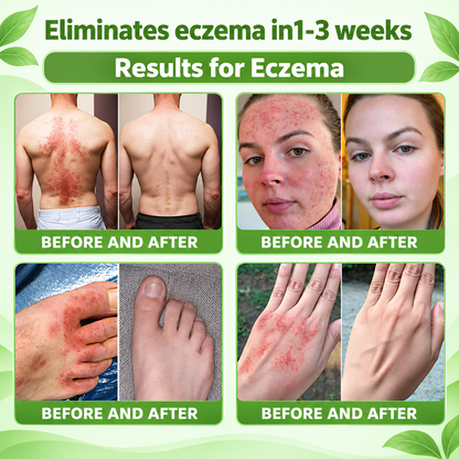 𝐏𝐔𝐑𝐄𝐋𝐎𝐑𝐀® 👩‍⚕️👩‍⚕️ 𝑰𝑳-23𝑹 𝑨𝒏𝒕𝒂𝒈𝒐𝒏𝒊𝒔𝒕 𝑷𝒆𝒑𝒕𝒊𝒅𝒆 + 𝑰𝒏𝒅𝒊𝒓𝒖𝒃𝒊𝒏 10-𝑰𝑵-1 𝑵𝒂𝒏𝒐 𝑴𝒊𝒄𝒓𝒐𝒏𝒆𝒆𝒅𝒍𝒆 𝑷𝒂𝒕𝒄𝒉 （𝑯𝒆𝒍𝒑𝒔 𝑹𝒆𝒅𝒖𝒄𝒆 𝑽𝒊𝒔𝒊𝒃𝒍𝒆 𝑹𝒆𝒅𝒏𝒆𝒔𝒔 & 𝑺𝒄𝒂𝒍𝒊𝒏𝒈, 𝑺𝒐𝒐𝒕𝒉𝒆 𝑫𝒓𝒚𝒏𝒆𝒔𝒔 & 𝑰𝒕𝒄𝒉𝒊𝒏𝒈, 𝑺𝒖𝒑𝒑𝒐𝒓𝒕 𝑯𝒆𝒂𝒍𝒕𝒉𝒊𝒆𝒓 𝑺𝒌𝒊𝒏 𝑪𝒆𝒍𝒍 𝑻𝒖𝒓𝒏𝒐𝒗𝒆𝒓 & 𝑺𝒌𝒊𝒏 𝑩𝒂𝒓𝒓𝒊𝒆𝒓 𝑹𝒆𝒑𝒂𝒊𝒓）
